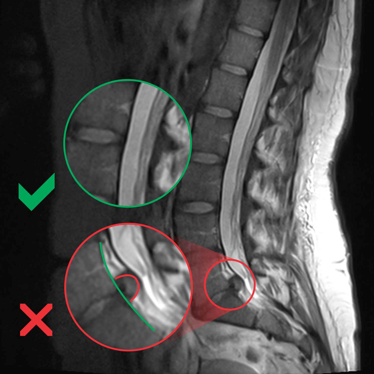 MRI, hernija diska, diskus hernija