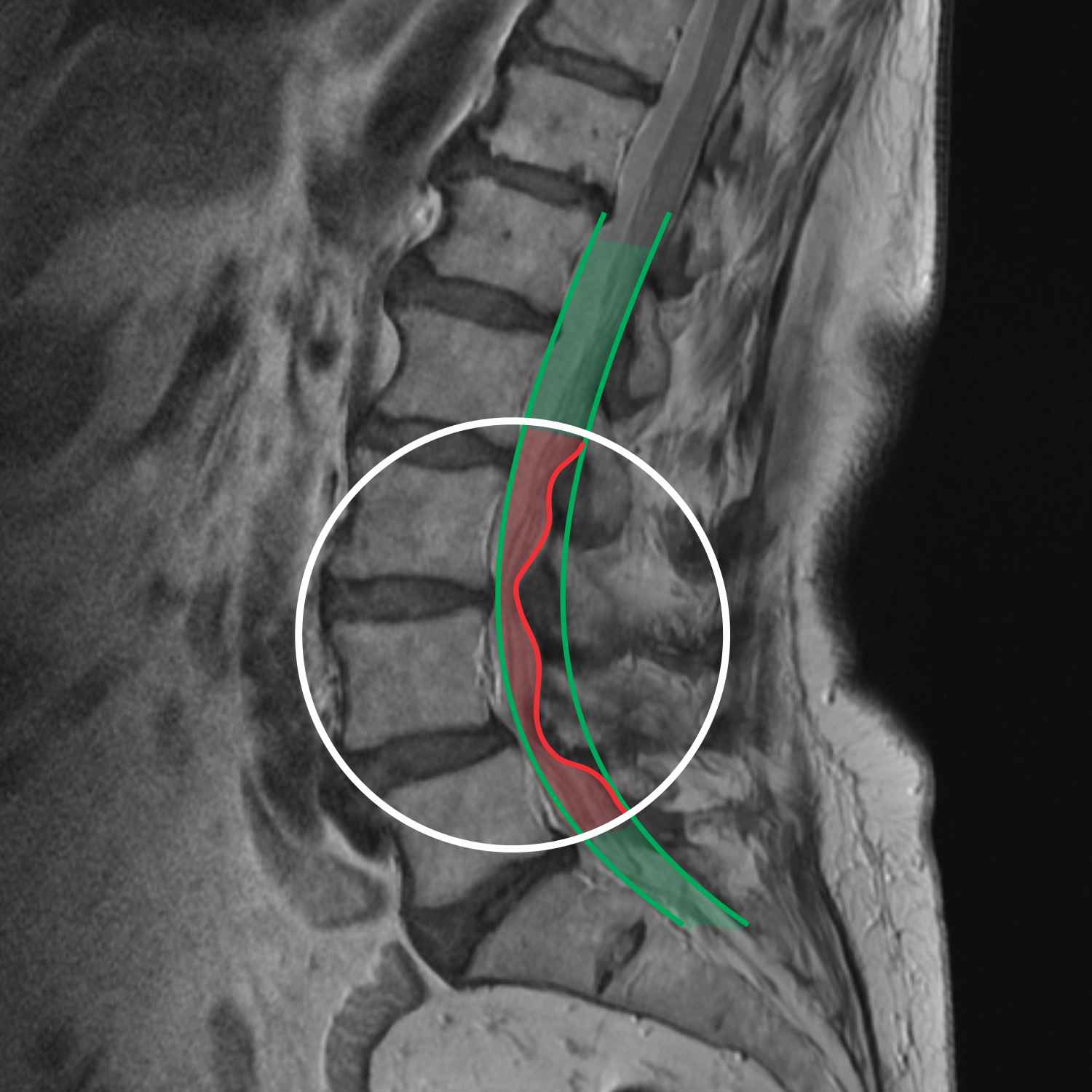 MRI spinalna stenoza, stenoza spinalnega kanala, vratna hrbtenica