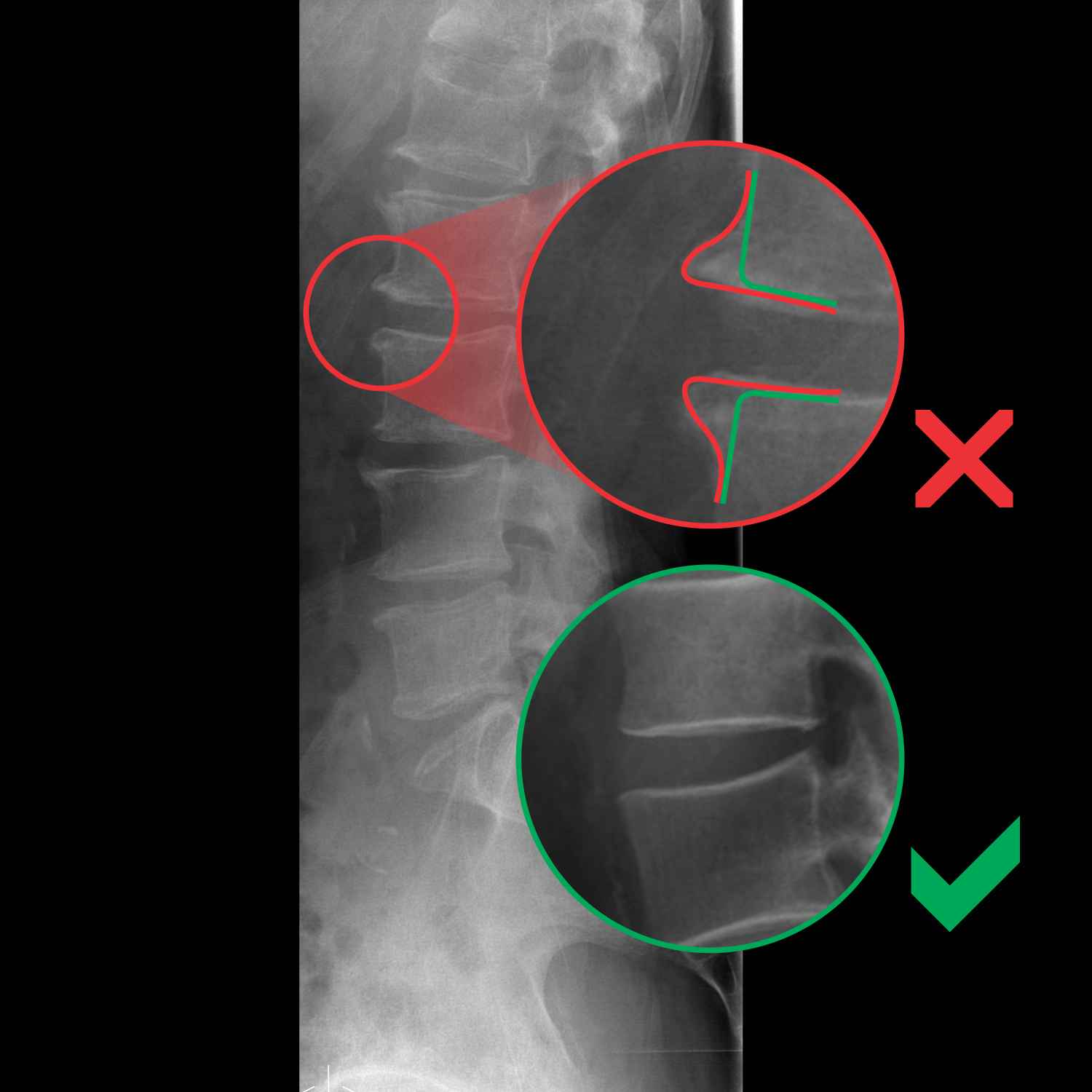 MRI spondiloza, izrastki iz vretenc, hrbtenica